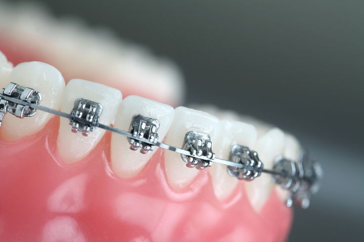 Braces