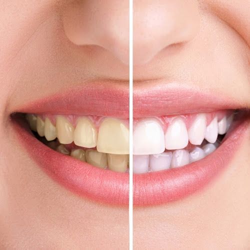 Teeth Whitening