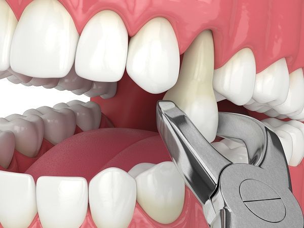 Teeth Extraction