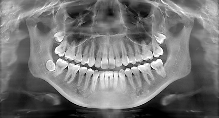 IOPA (X-ray)