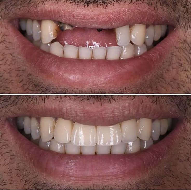 Teeth Filling